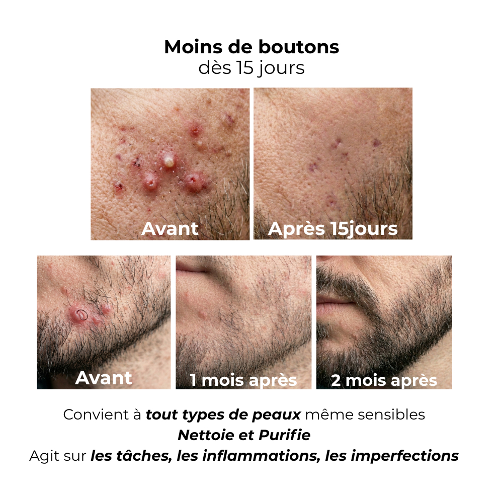 L'Éponge purifiante anti-imperfection : Le soin complet pour un Visage Pur